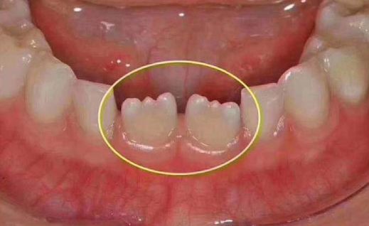 點解孩子換牙期居然變成鋸齒牙？