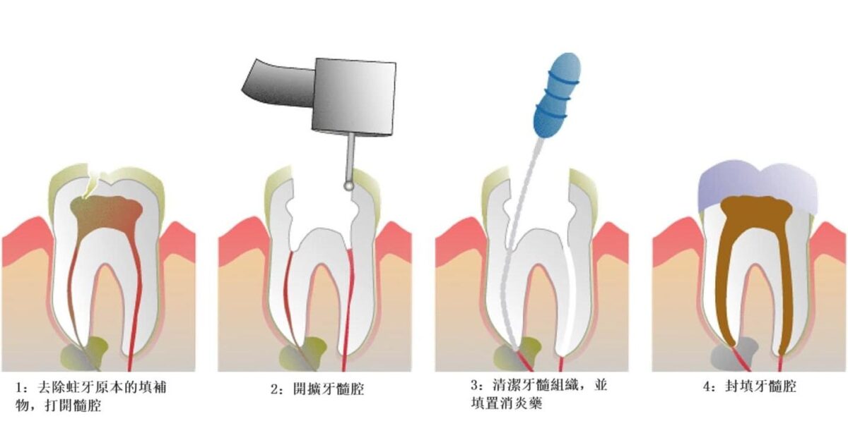 杜牙根原理及流程示意圖-1-1200x597